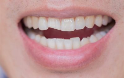 Dental Care: What Should I Do If I Ever Have A Chipped Tooth?