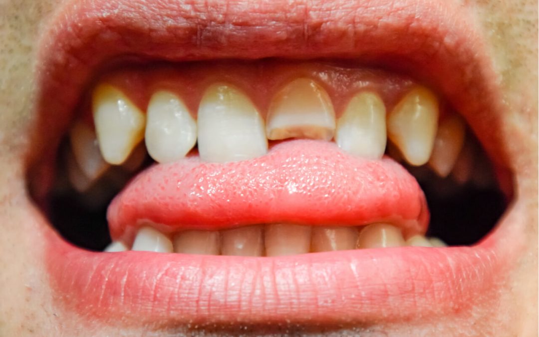 broken crown tooth