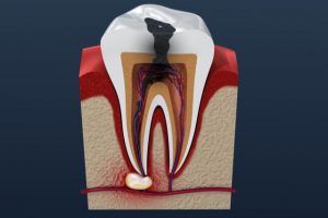 tooth abscess pus build up