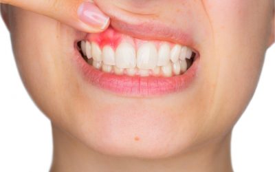 Tooth Abscess (Symptoms, Causes and Treatment You Can Get)