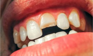 tooth fracture treatment