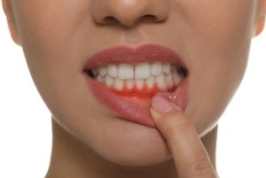 what does a tooth abscess look like gums