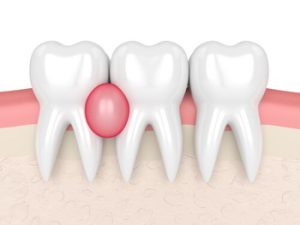 tooth abscess drainage pus adelaide