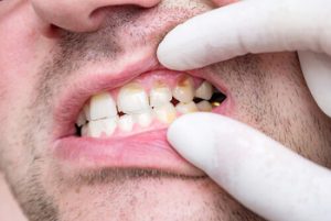 tooth abscess causes signs adelaide