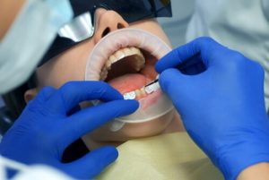 Chipped Front Tooth Before and After procedure
