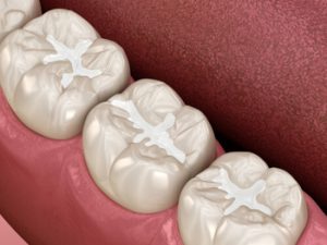 Crown vs Filling Chipped Tooth procedure