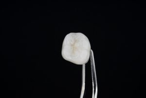 Crown vs Filling Chipped Tooth treatment