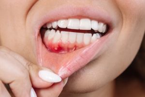 What Does a Chipped Tooth Feel Like infection