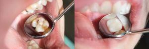 How Long Does Wisdom Tooth Pain Last results