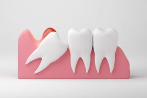 Why Does Wisdom Tooth Pain Come and Go symptoms