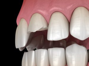 tooth broken root still in gums