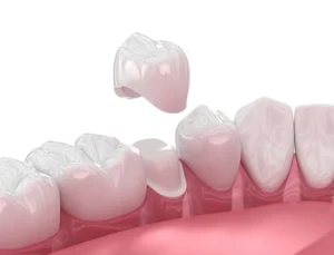 Broken Tooth Pain crown
