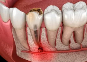 illustration of a Tiny Black Spot on Tooth
