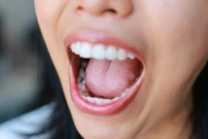 Broken Front Tooth causes