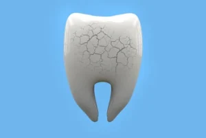 broken or cracked tooth extraction