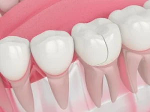 Can TMJ Cause Tooth Pain crack