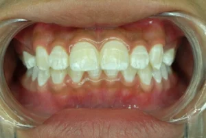 What Are The 4 Causes Of Tooth Decay check