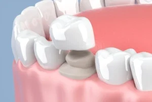 illustration of a dental crown