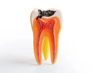 broken tooth exposed pulp root