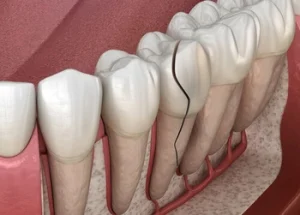 cracked tooth needing a root canal