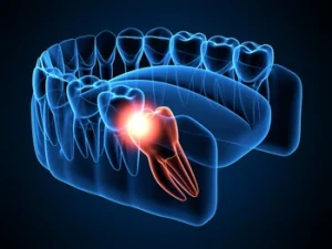 impacted wisdom tooth illustration